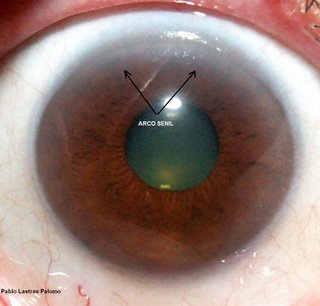 Iridologia. Arco senil